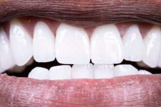 What Is a Calculus Bridge? And How to Prevent One on Your Teeth