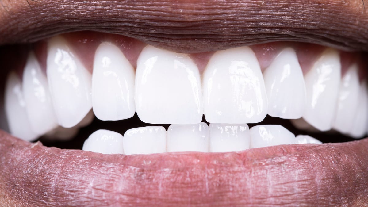 What Is a Calculus Bridge? And How to Prevent One on Your Teeth