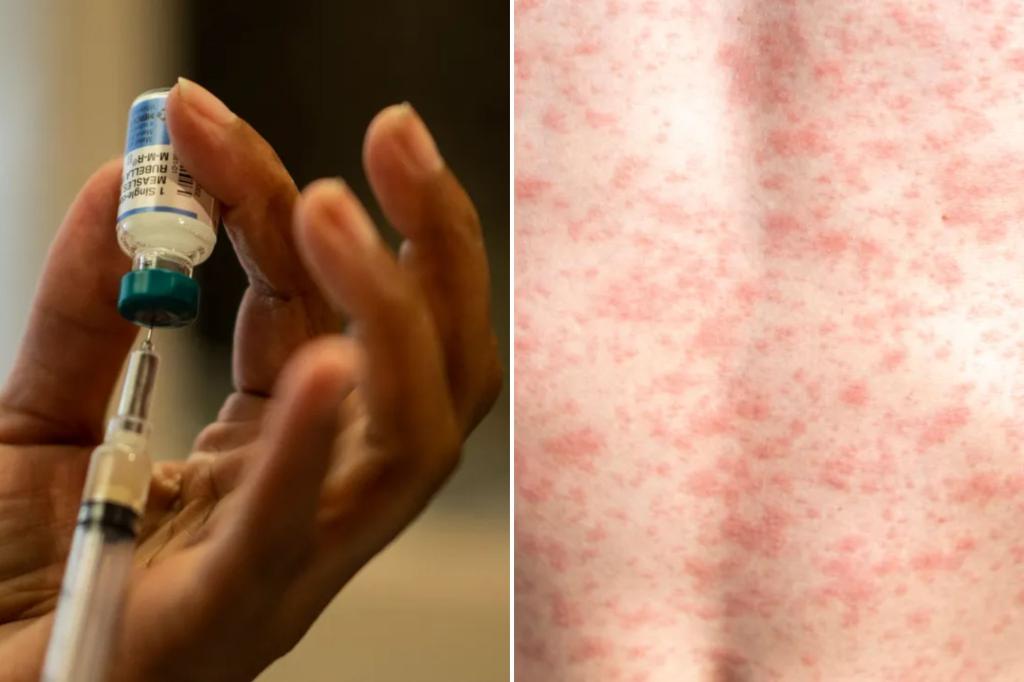 Measles alert issued in New Jersey county following three confirmed cases