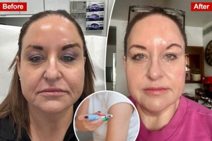 Exclusive | Post-jab nip/tuck: People with ‘Ozempic face’ are fixing it with these procedures to fight wrinkles and sagging