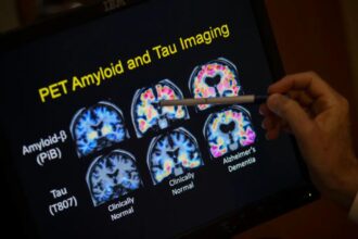 FDA approves blood test that can help diagnose Alzheimer’s disease