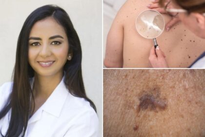 The ‘ABCDEs’ of skin cancer — 9 clues you shouldn’t ignore