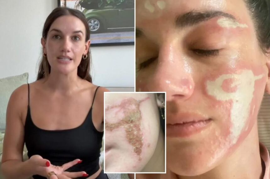 My session with a celebrity aesthetician left me burned, scarred and irreparably damaged