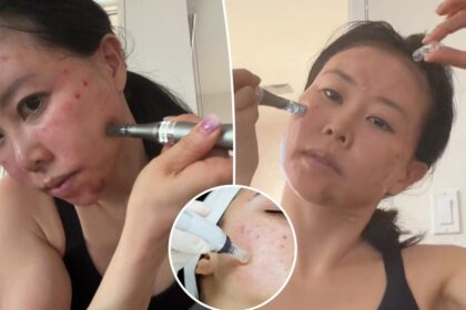 This popular DIY skincare tool can scar you for life, experts warn — and it won’t give a ‘real’ collagen boost either