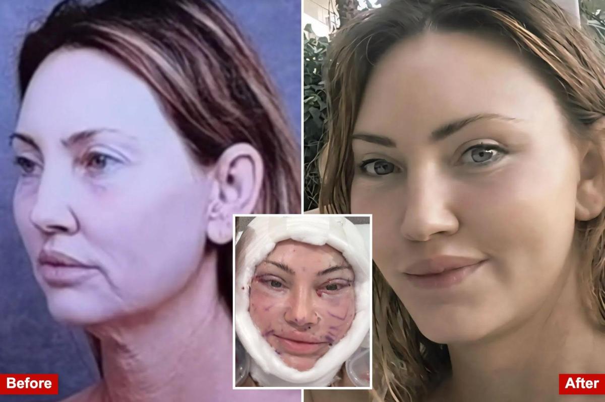 Exclusive | I had a 0,000 Beverly Hills facelift — and then shared every intimate detail with the world