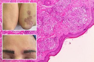 How a popular makeup trend triggered one woman’s full-body disease