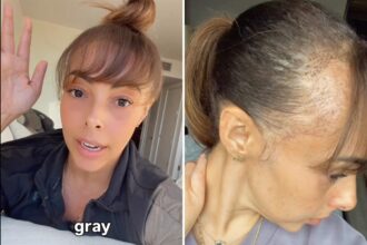 Hair transplant came with a rare side effect — patient’s doctor was even stunned: ‘This has never happened before’