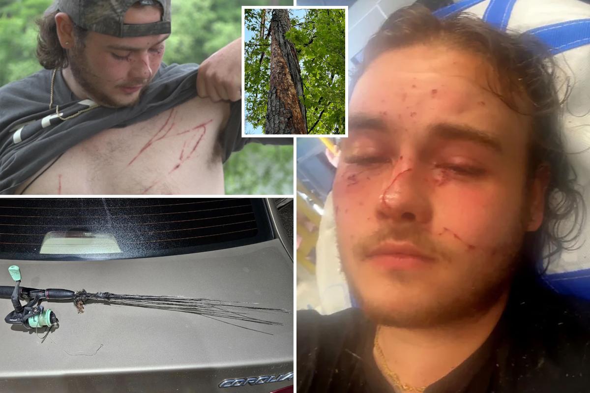 Fisherman survives lightning strike that left him covered in burns: ‘Unluckiest lucky man alive’