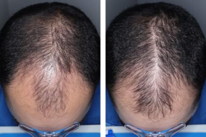 Experimental hair loss pill just cleared a major hurdle — when it could hit shelves