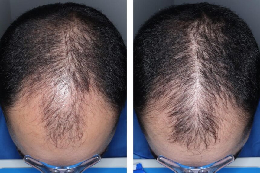 Experimental hair loss pill just cleared a major hurdle — when it could hit shelves
