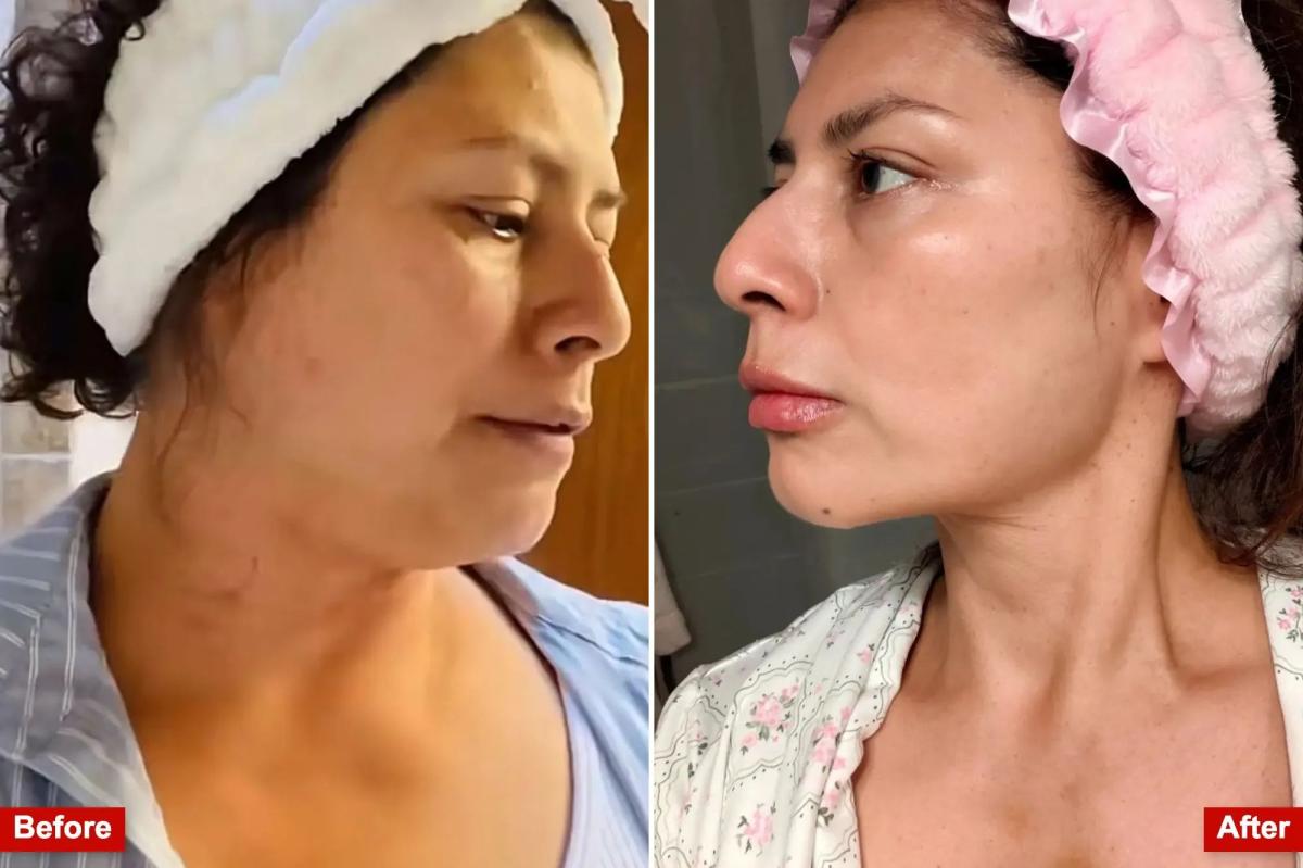 Exclusive | Meet the women performing at-home liposuction on themselves with shady  kits to shed weight
