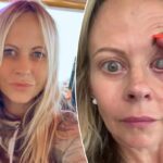My eye had to be sewn shut after a parasite ate my cornea — the crucial mistake I made