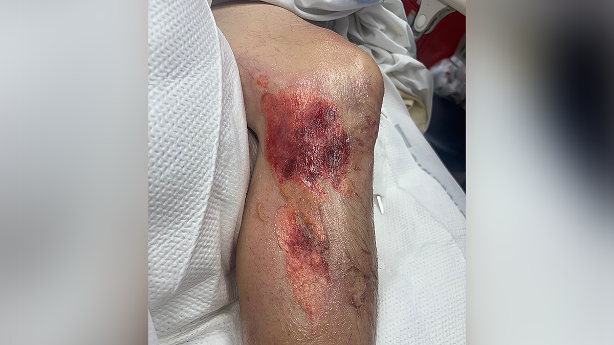 Grant Siler suffered second- and third-degree burns
