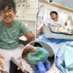 Boy, 12, undergoes skin graft after sun exposure caused popular toy to explode