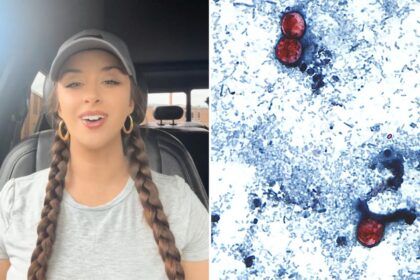 TikTok food critic, 29, details ‘miserable’ experience of contracting ‘explosive diarrhea’ parasite