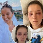 Bride-to-be sounds alarm after popular beauty treatment left her disfigured before the big day