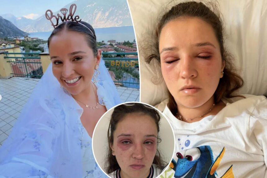 Bride-to-be sounds alarm after popular beauty treatment left her disfigured before the big day